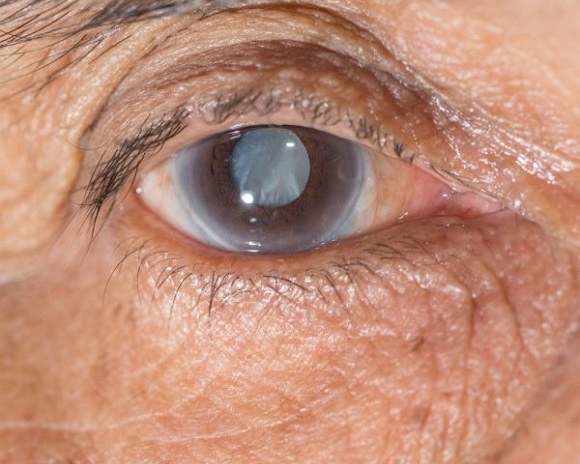Операция по поводу катаракты улучшает когнитивные функции