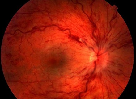 Болезни сосудов могут стать причиной потери зрения