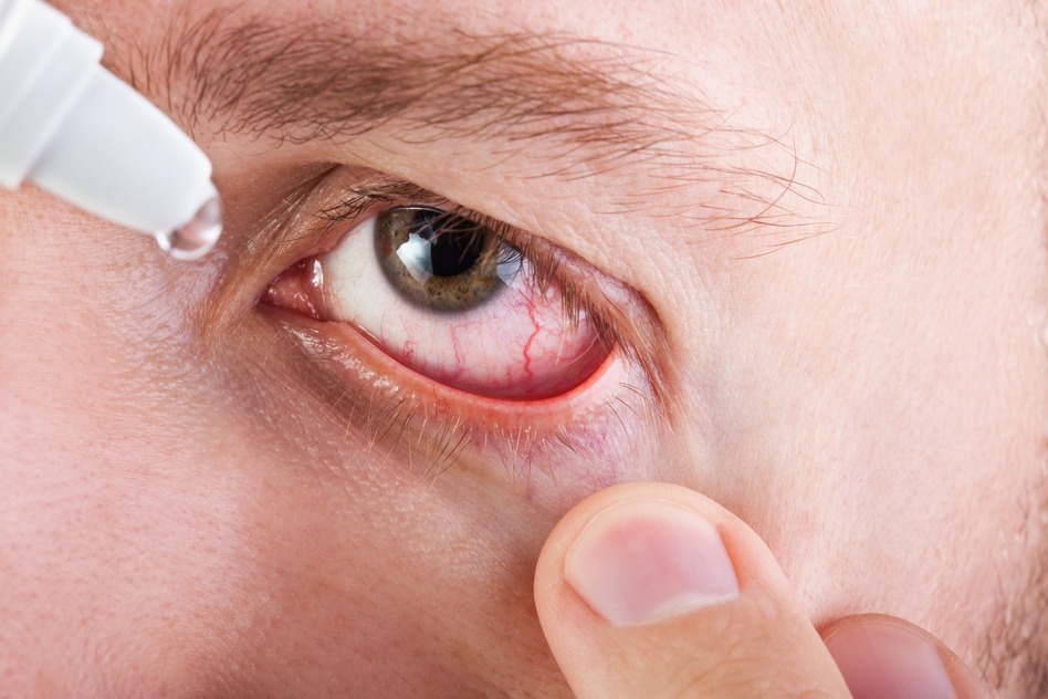 Растет число людей, страдающих синдромом сухого глаза