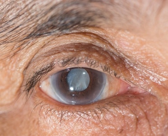 Избавиться от катаракты без операции возможно, утверждают ученые