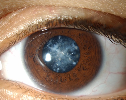 Глазные капли помогут вылечить катаракту