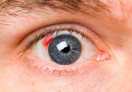 Запатентовано новое лекарство от диабетической ретинопатии