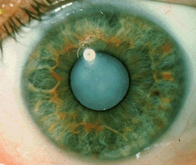 Риск развития катаракты снижают статины