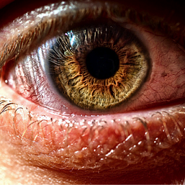 Синдром сухого глаза