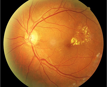Диагностика заболеваний по сетчатке глаза
