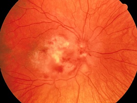 Болезнь Коатса (ретинит) - сетчатка, ретинит, Коатса, ретинопатия