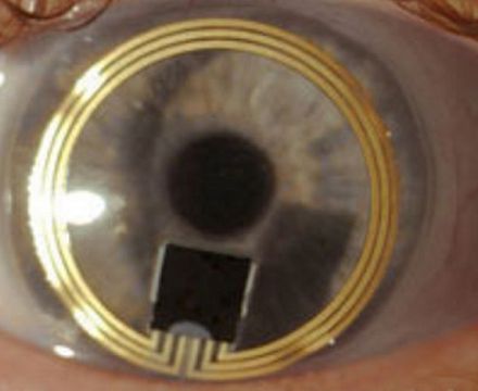 Глаукома будет взята под контроль с помощью внутриглазного сенсора