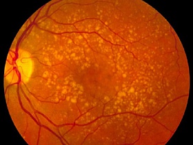В России растет заболеваемость ВМД - лечение глаз, макулярная дистрофия