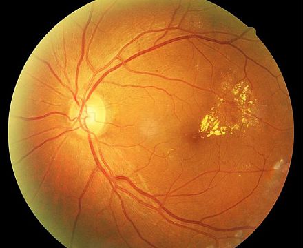 Антиангиогенные средства в борьбе со слепотой