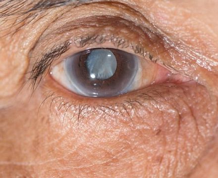 Операция по поводу катаракты улучшает когнитивные функции