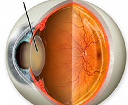 Лечение катаракты глаза без операции - все методы!