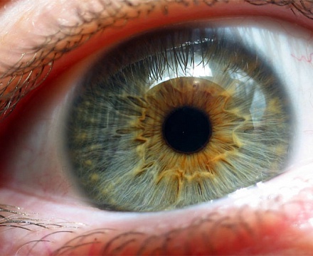 Меланоз глаз (меланопатия)