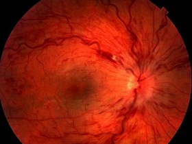 Болезни сосудов могут стать причиной потери зрения - здоровье глаз, сетчатка