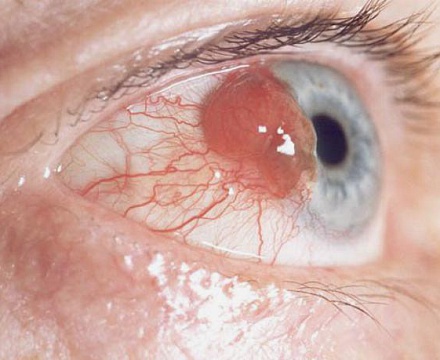 Злокачественная опухоль глаза: виды, симптомы, лечение
