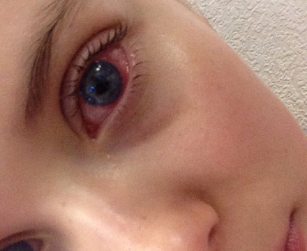 Почему болят глаза - причины и лечение
