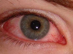 О воспалительных процессах в глазах и их лечении - воспаление глаз, конъюктивит, кератит