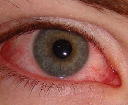 О воспалительных процессах в глазах и их лечении