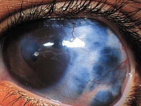 Предложен оригинальный метод лечения глаукомы - глаукома, здоровье глаз