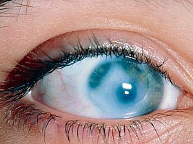 Как снизить внутриглазное давление  - глаукома