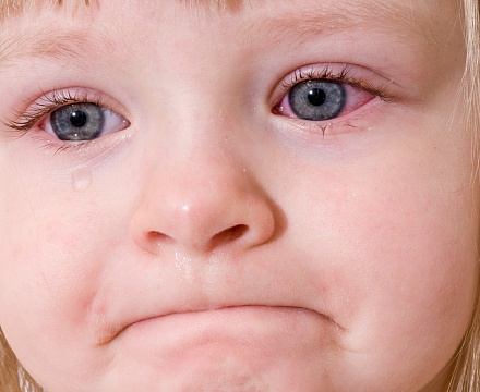 Покраснение глаз у ребенка: методы лечения