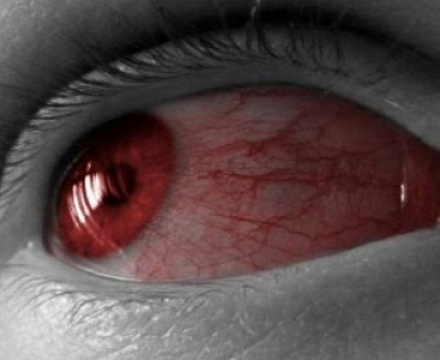 Красные белки глаз – что делать?