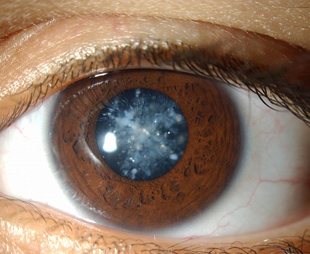 Что такое катаракта