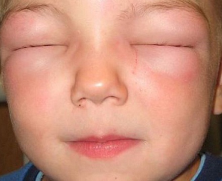 Если глаз опух: диагностика и рекомендации