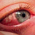 Ранение глаза