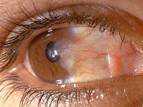 Нарост на роговице глаза - роговица, болезни глаз