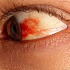 Кровоизлияние глаза
