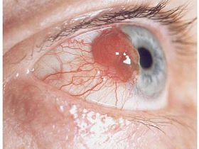 Злокачественная опухоль глаза: виды, симптомы, лечение - рак глаза, опухоль глаза