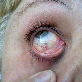 Пожелтели белки глаз: причины, лечение