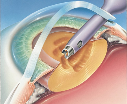 Осложнения операции по удалению катаракты