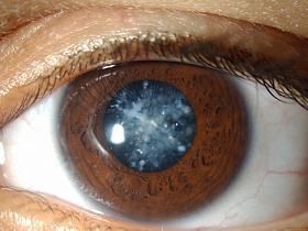 Глазные капли помогут вылечить катаракту - катаракта, научные исследования, глазные капли